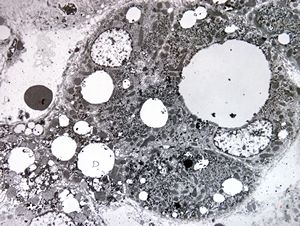 M,14y. | steatosis